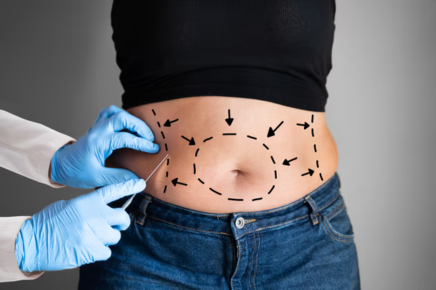 Türkiye’de Liposuction (Yağ Aldırma Ameliyatı)